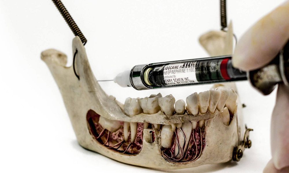 Dental Anesthesia