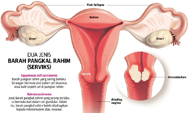 Image result for kanser serviks pil perancang
