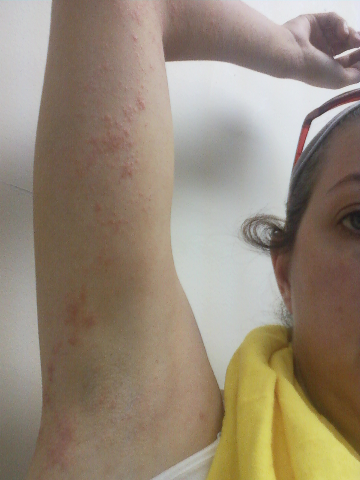 What Is a Diabetic Rash? with pictures