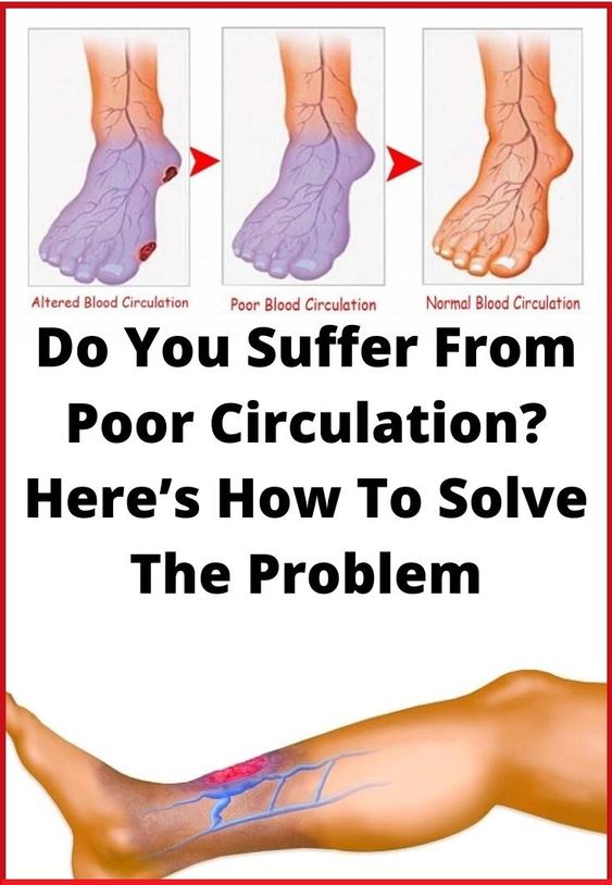 Do You Suffer From Poor Circulation? Here’s How To Solve The Problem