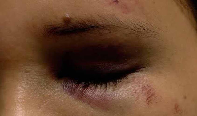 Homem dá soco no rosto da esposa adolescente por ciúmes do vestido que ela usava 2 Homem dá soco no rosto da esposa adolescente por ciúmes do vestido que ela usava