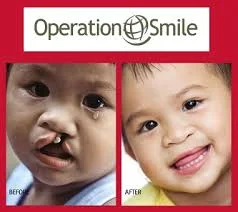 Before and After of child with cleft lip