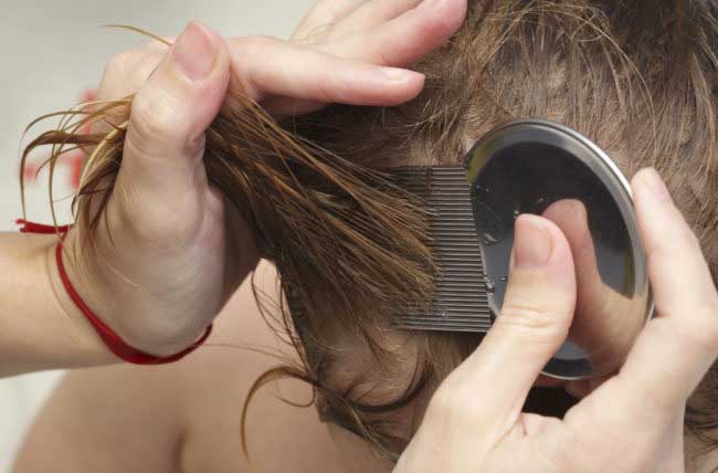 How to Remove Dead Lice Eggs from Hair