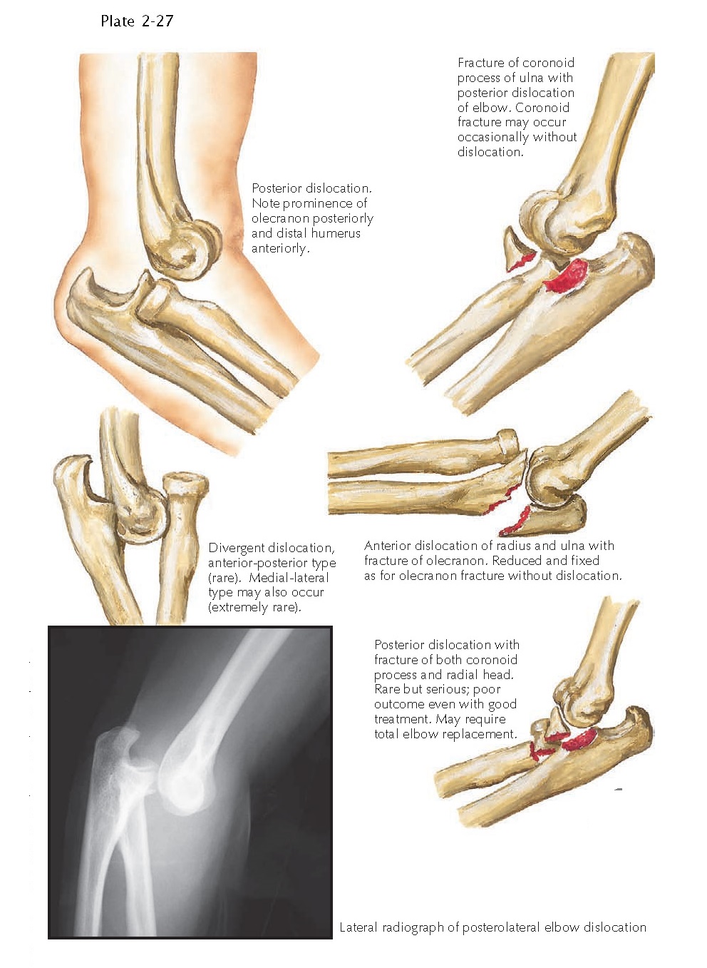 DISLOCATION OF ELBOW JOINT pediagenosis