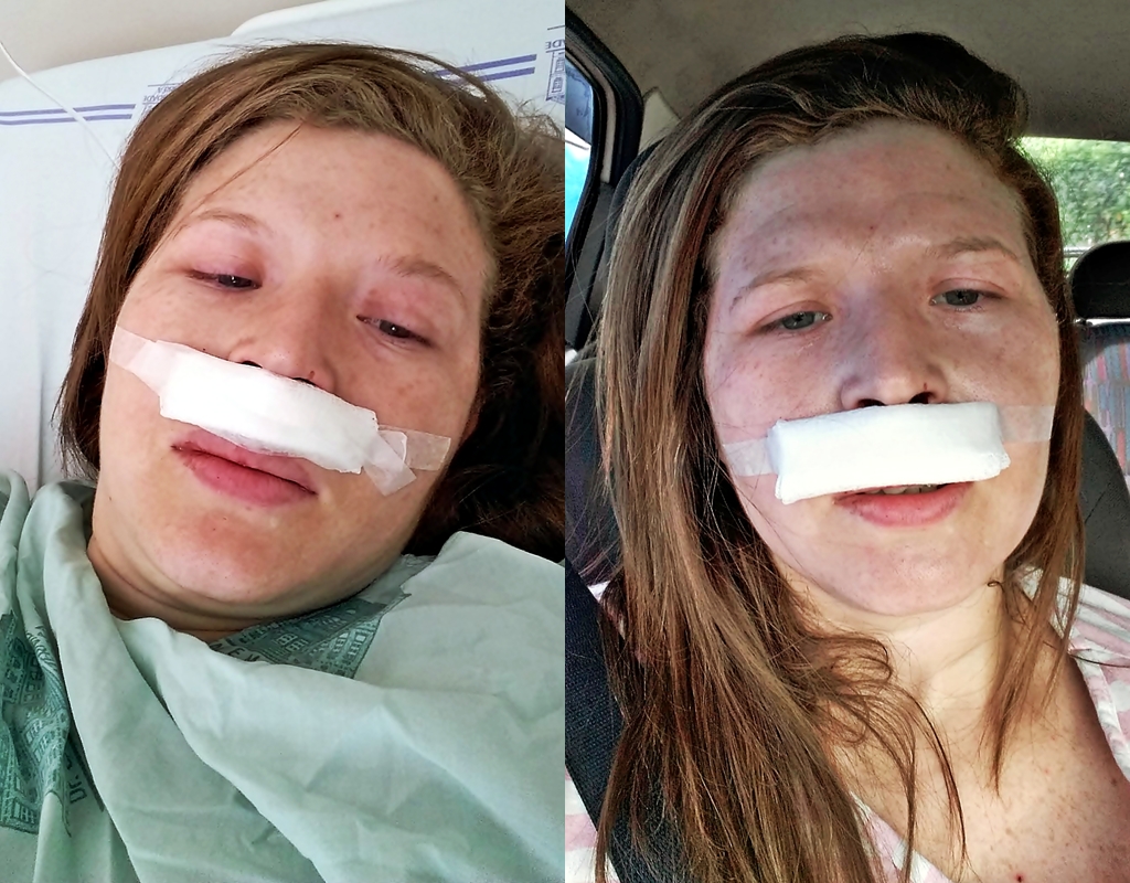 Cirurgia Desvio De Septo Antes E Depois Arrasando e na Moda: MINHA CIRURGIA DE DESVIO DE SEPTO - COM FOTOS