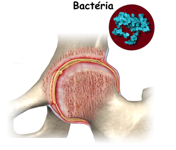 artrite bacteriana não gonocócica)