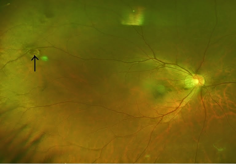 All things eye Por Yong Ming Floaters, flashes of light and retina