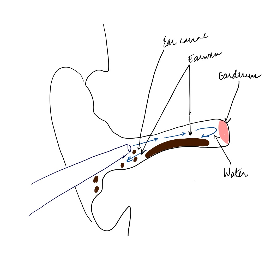 Medicowesome Ear Syringing