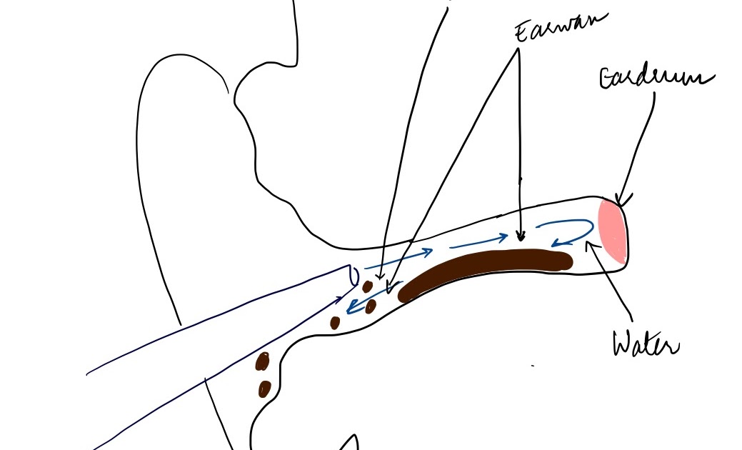 Medicowesome Ear Syringing