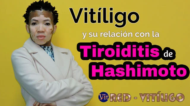Vitiligo y su relación con tiroiditis de hashimoto