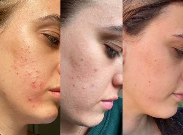 Comment se débarrasser de l'acné dans la trentaine - conseils
