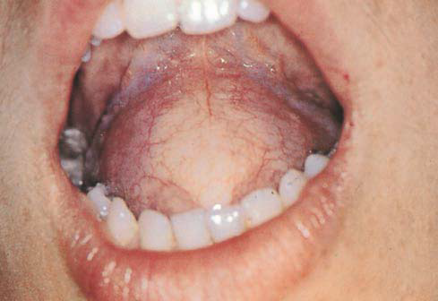 Epidermoid cyst localized in the palatine tonsil