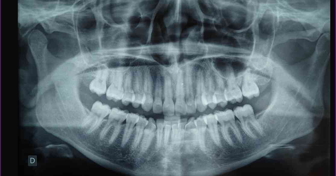 Mon expérience de l’orthodontie adulte par gouttières type