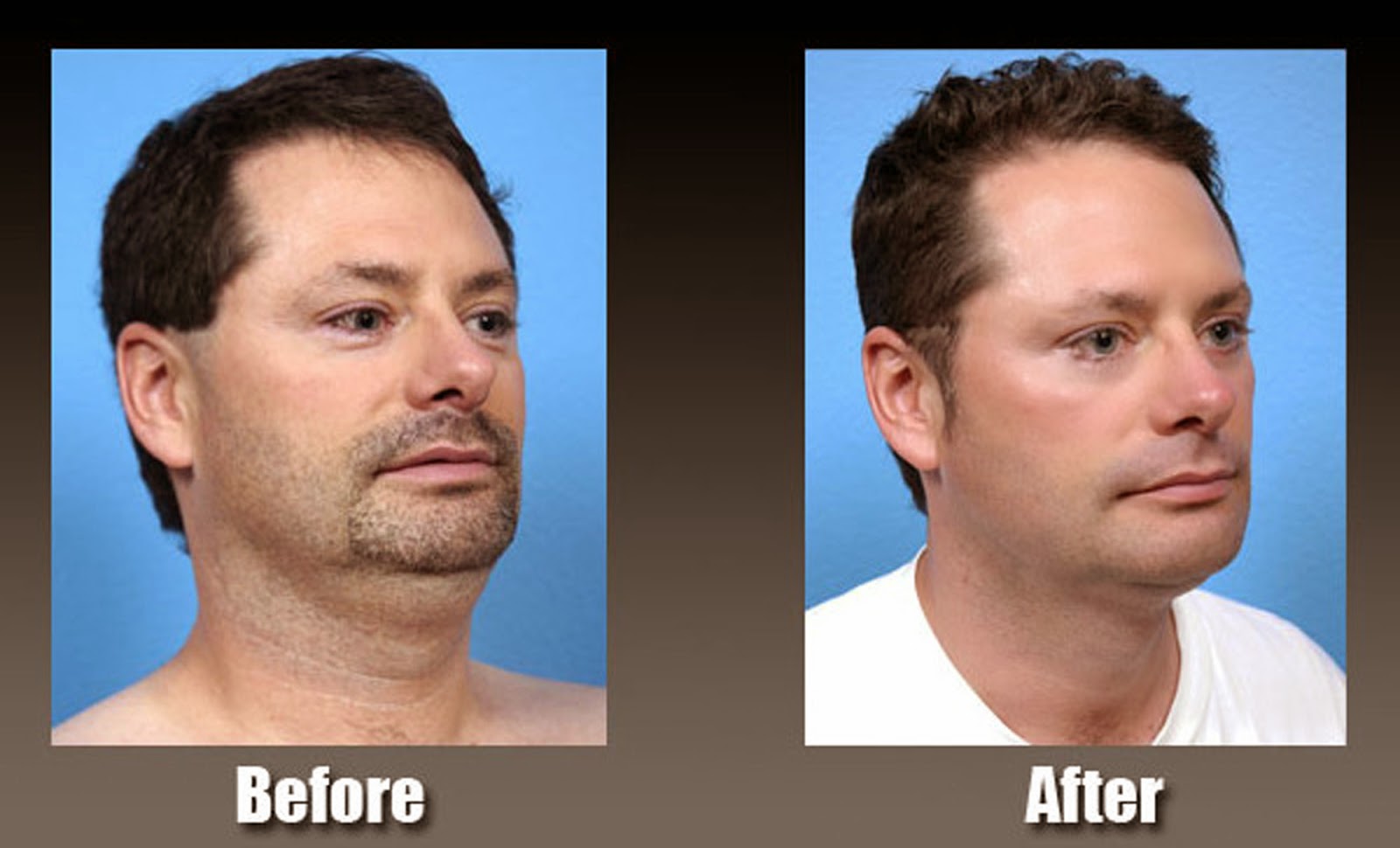 Liposuction Las Vegas