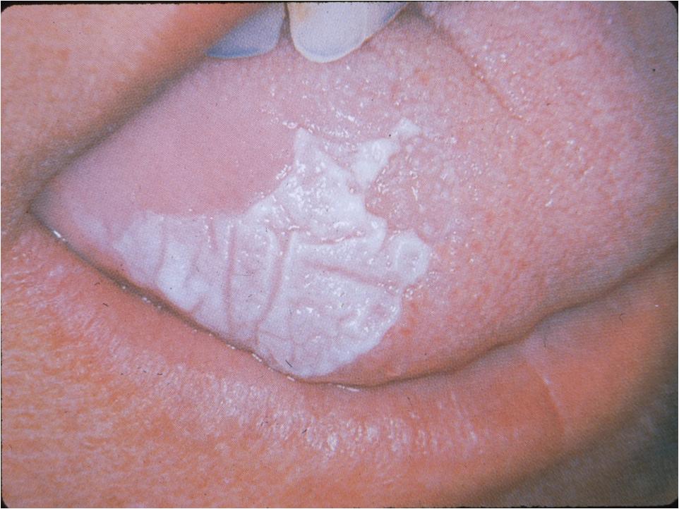 Dentistry lectures for MFDS/MJDF/NBDE/ORE: Facts on ... diagram of squamous cell carcinoma 