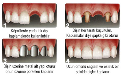 Dislerde Kopru