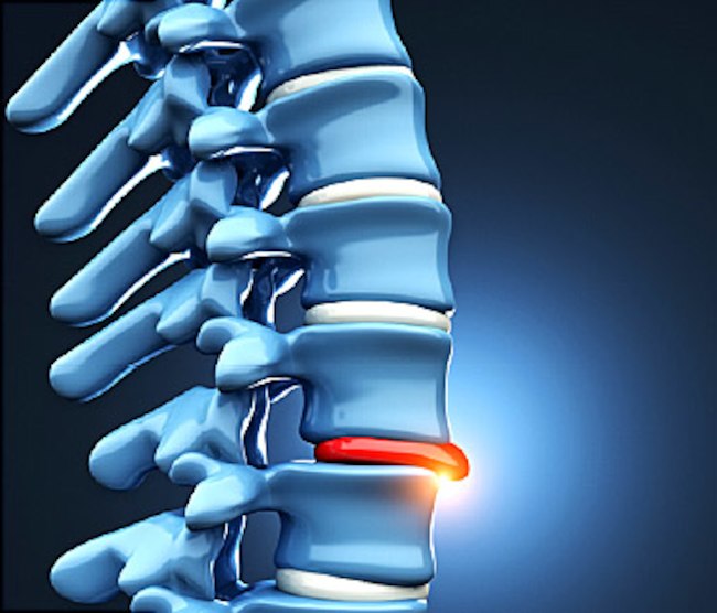 SCIATICA PAIN Causes, Symptoms, Prevention and Treatment