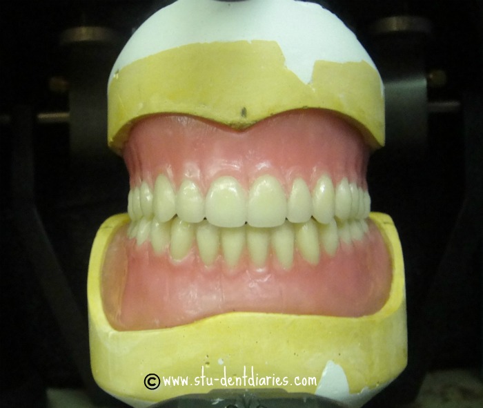 StuDENT Diaries Removable Prosthodontics Complete Dentures