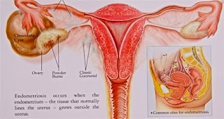 Informasi Pertumbuhan Penyakit Kista Endometriosis