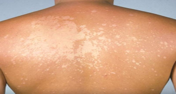 Pityriasis Rosé De Gibert Traitement Naturel Remèdes naturels pour le pityriasis versicolor | The Motive Mag