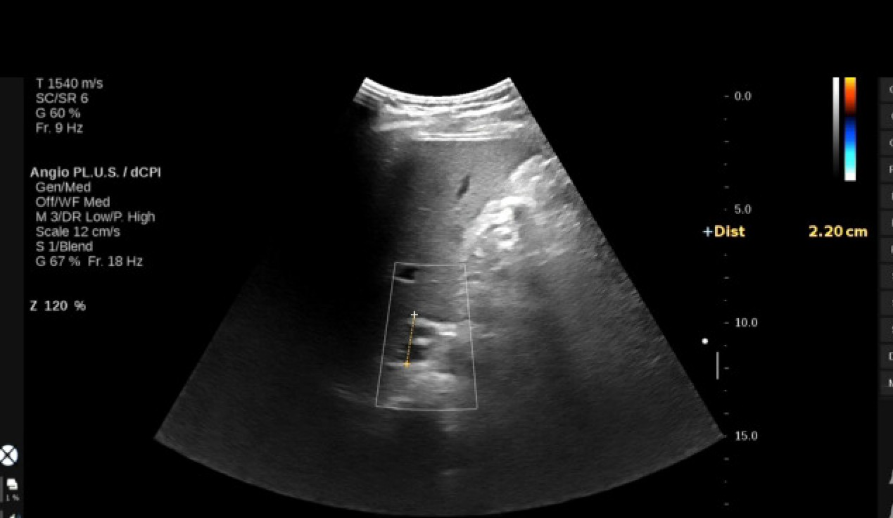 VIETNAMESE MEDIC ULTRASOUND CASE 576ECTOPIC LIVER TISSUE or ADRENAL