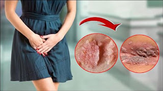 Obat kutil kelamin atau kutil di kemaluan yang bagus di apotik, Bahaya Kutil Kemaluan Pada Wanita Hamil, Obat Kutil Kelamin Atau Kutil Di Kemaluan Alami, Seperti Kutil Di Kemaluan, Obat Kutil Genitalis (Kondiloma Akuminata), Jual Obat Kutil Kelamin, Pengobatan Kutil Kelamin Atau Kutil Di Kemaluan Di Bandung, Menghilangkan Kutil Kelamin Atau Kutil Di Kemaluan Tradisional, Obat Kutil Kelamin Atau Kutil Di Kemaluan Aman Untuk Ibu Hamil, Obat Kutil Kelamin Atau Kutil Di Kemaluan Aman Buat Ibu Hamil, Obat Tradisional Kutil Kelamin Luar