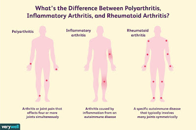 What is polyarthritis?