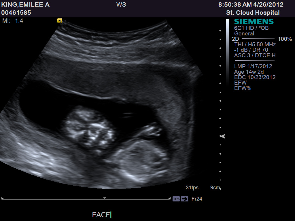 Lillie Mae 14 Week Ultrasound Pictures