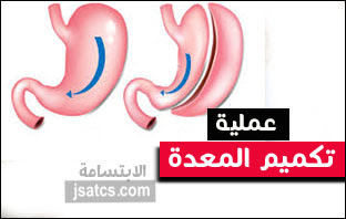 أرخص عملية تكميم المعدة في الرياض أرخص 35 مرة مع العروض الحصرية