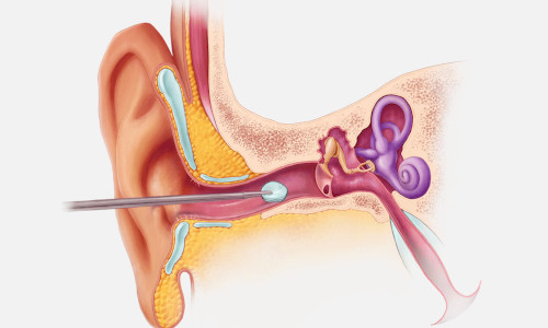 ear-drums-implant
