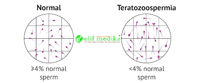 Normozoospermia dan Teratozoospermia Normozoospermia dan Teratozoospermia