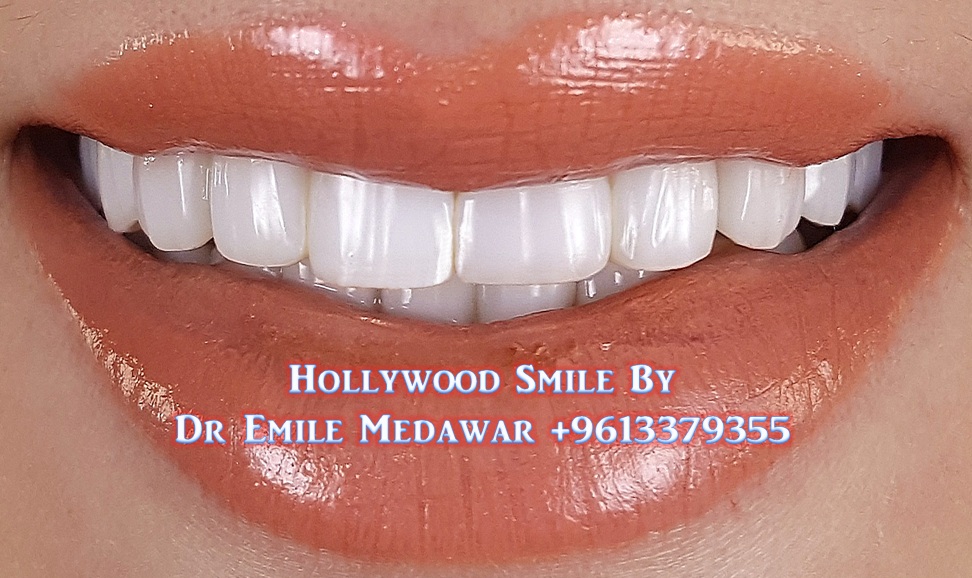 UltraThin Porcelain Veneers, EMax Veneers, Direct Composite Veneers