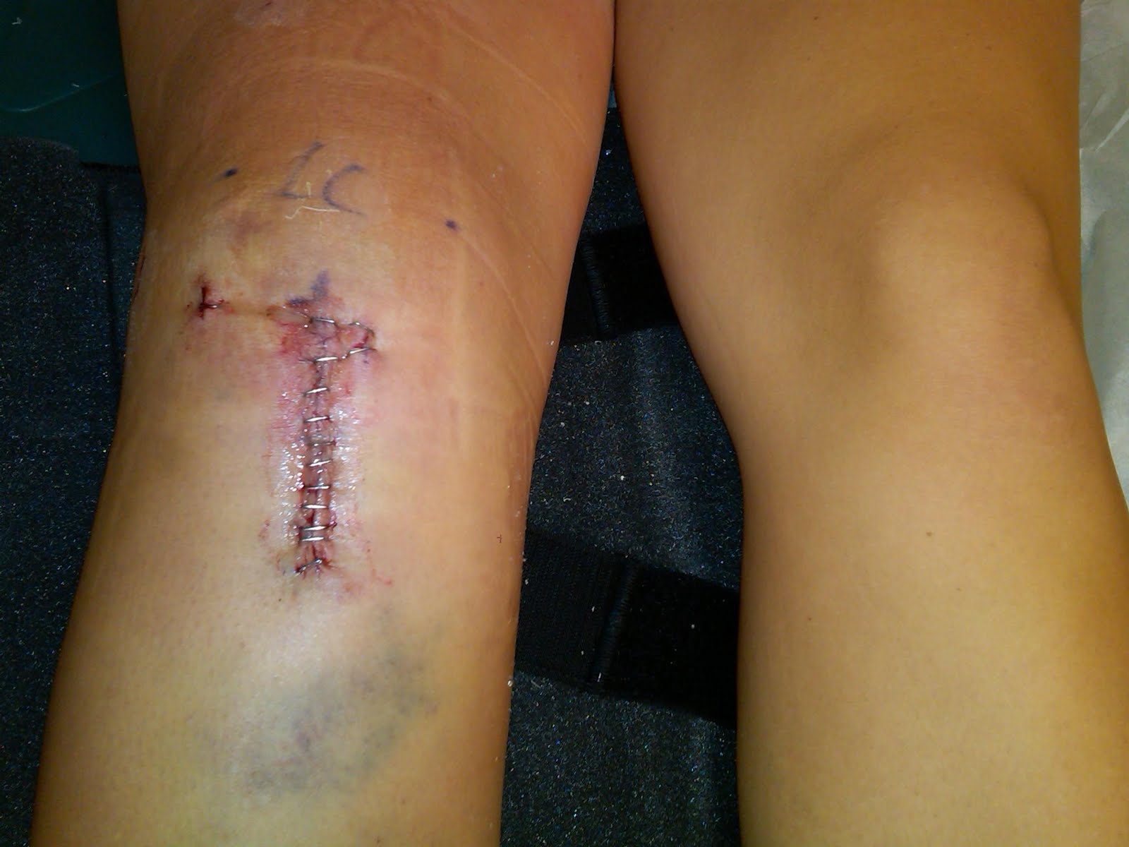 ACL Surgery & Recovery The Day After...