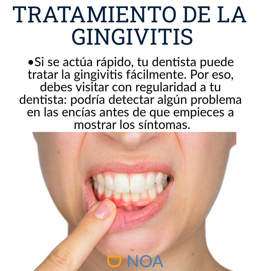 ¿Qué es la Gingivitis?
