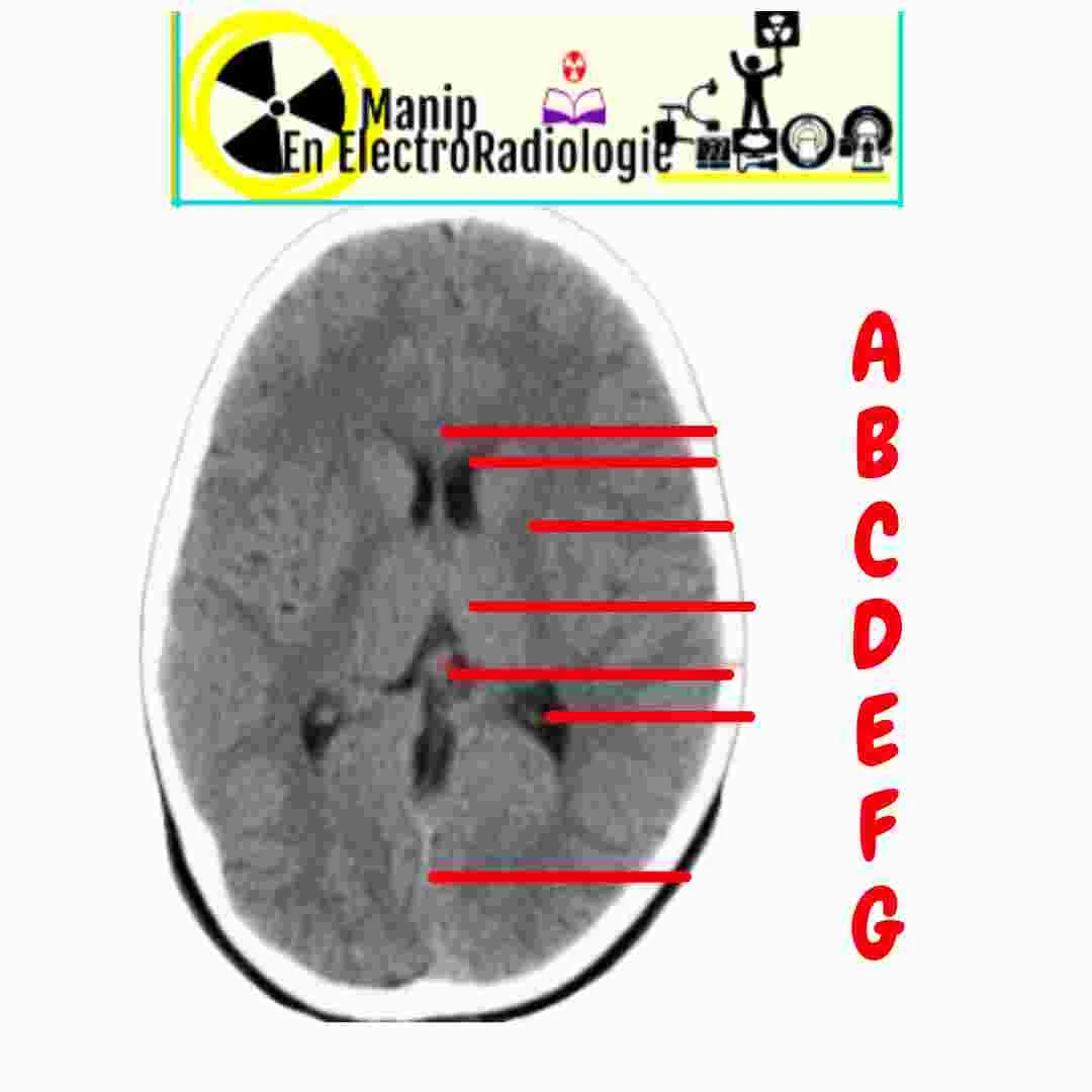 Structures anatomiques du tdm cérébral normal au niveau du thalamus
