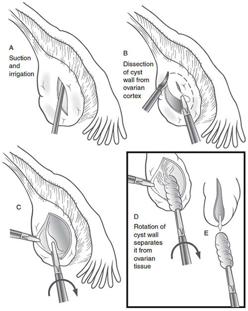 Laparoscopic management of an ovarian cyst