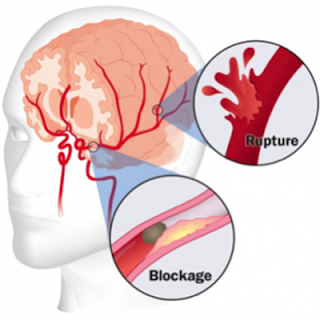 Resep Obat Tradisional Untuk Stroke, Pengobatan Untuk Stroke Mata, Olahraga Penyakit Stroke, Www Obat Stroke, Penyakit Minor Stroke, Cara Mengobati Kucing Stroke, Obat Herbal Untk Stroke, Pantangan Makanan Untuk Penyakit Stroke Ringan, Cara Membuat Obat Stroke Ringan, Obat Herbal Stroke Mujarab, Obat Herbal Untuk Penderita Stroke Ringan, Penyakit Stroke Menurut Islam, Cara Mengobati Penyakit Stroke Dengan Cara Alami, Obat Pencegah Stroke, Obat Herbal Stroke Iskemik 