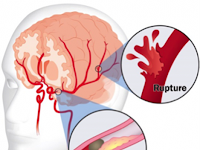 Obat Penyakit Stroke Mata