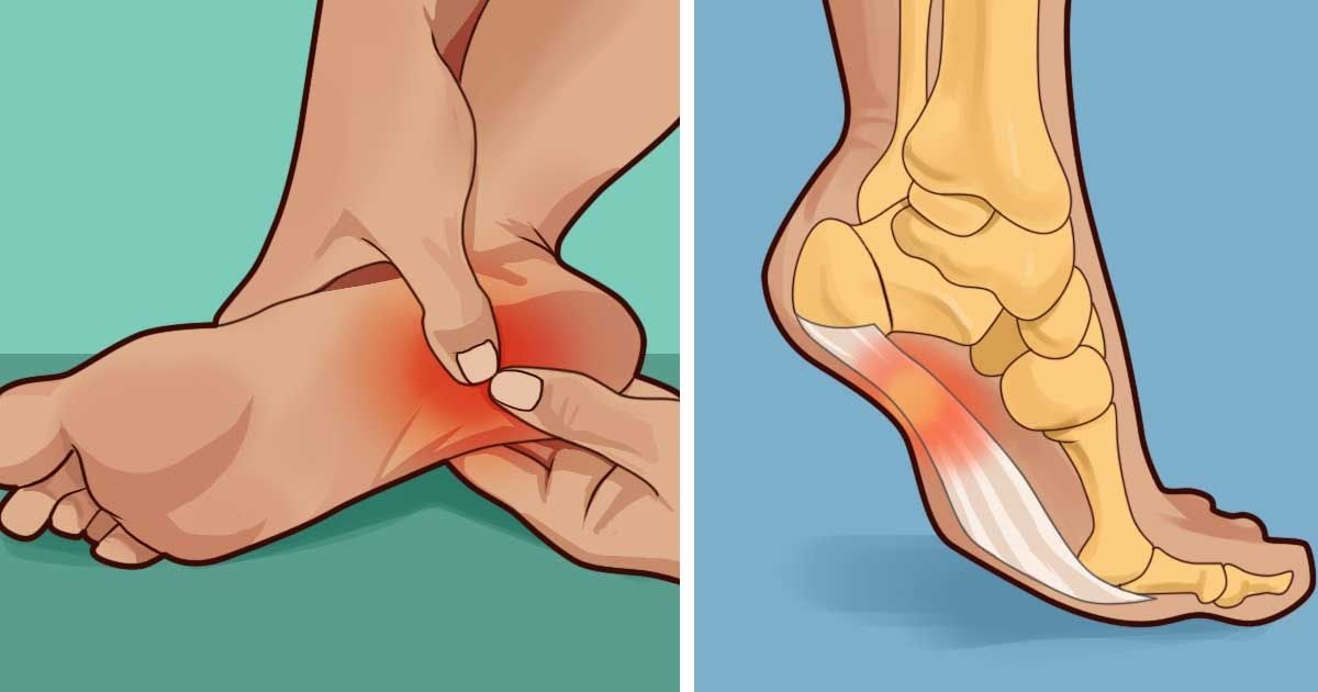How to treat and prevent plantar fasciitis at home Handy DIY