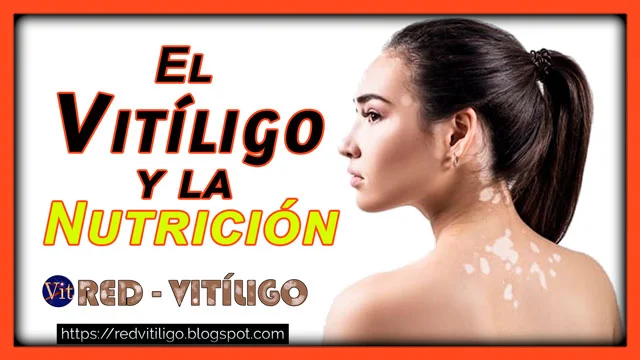 Vitiligo y la nutrición