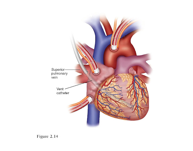 Similar image to Figure 2.13 but showing the right superior pulmonary vein and a cannula being advanced to the apex of the LV. A gloved hand can be placed behind the heart.