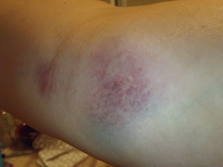 archery bruise