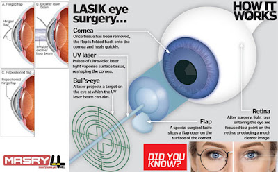 LASIK eye surgery ما هي جراحة العيون بالليزر - عملية الليزك