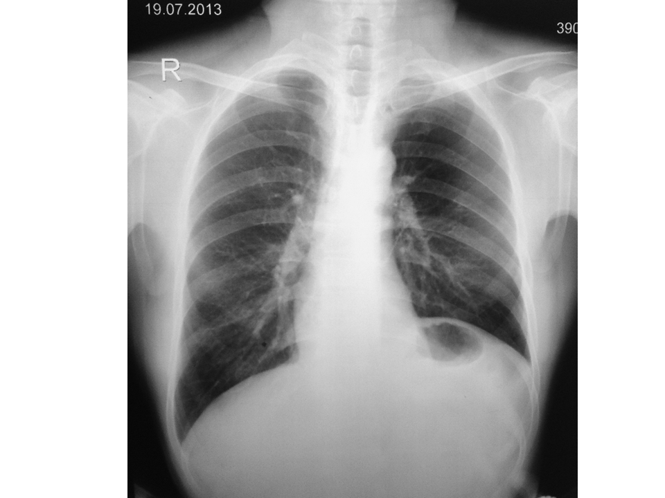 Diaphragmatic Paralysis Sniff Test – VQFFOU