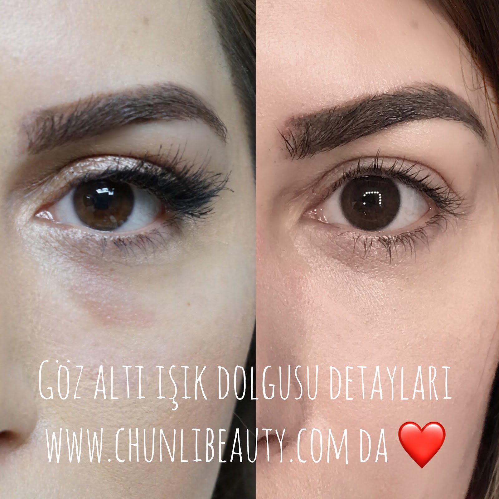 Goz Alti Isik Dolgusu Deneyimim 2 Op Dr Gokhan Haytoglu Chunli Beauty Bloglovin