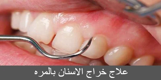 علاج خراج الاسنان بالمره