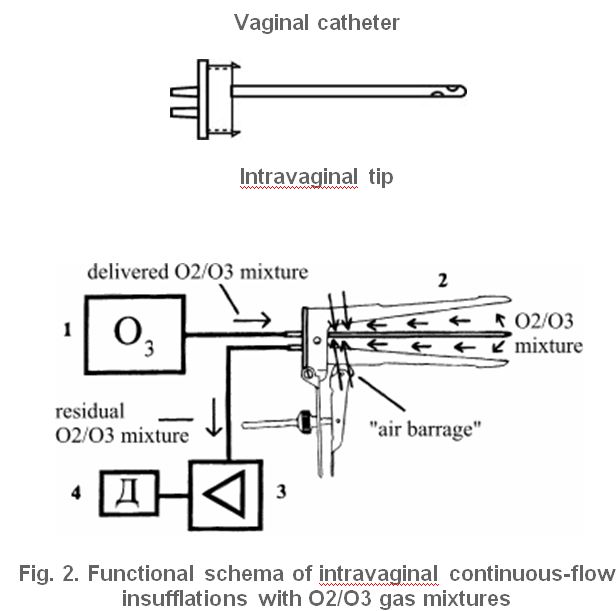 OZONE THERAPY OZONE OBSTETRICS & GYNAECOLOGY