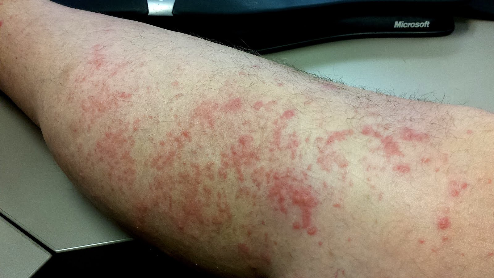 Do Chiggers Bite Dogs Dog Choices