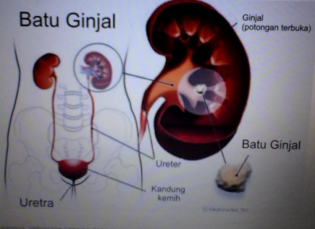 Manfaat Kencing Jongkok Sesuai Sunnah Nabi, Salah Satunya Mencegah Batu Ginjal