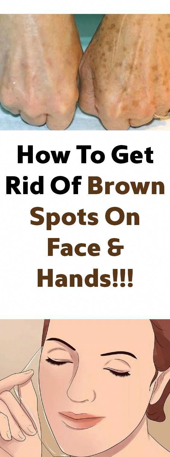 Naturally Remove Brown Spots On Face How To Get Rid Of Them Naturally